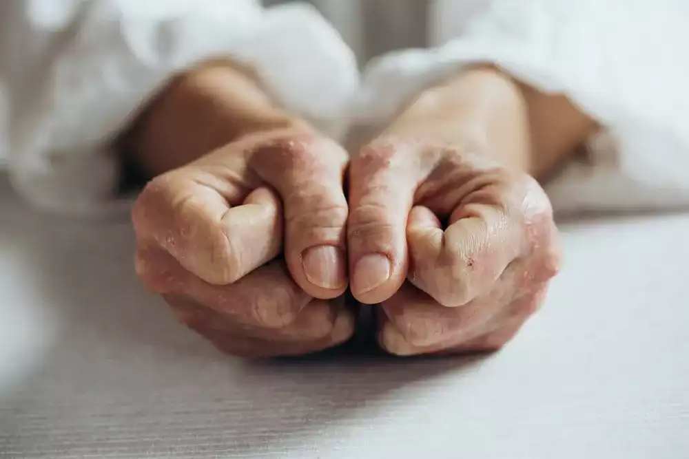 Psoriasis